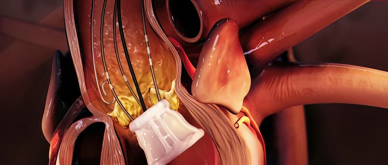 What is Aortic valve replacement?