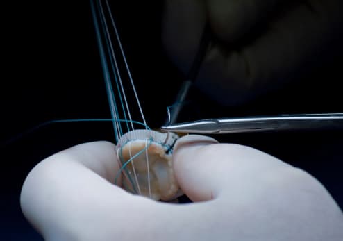 What is the surgery process of Aortic valve replacement?