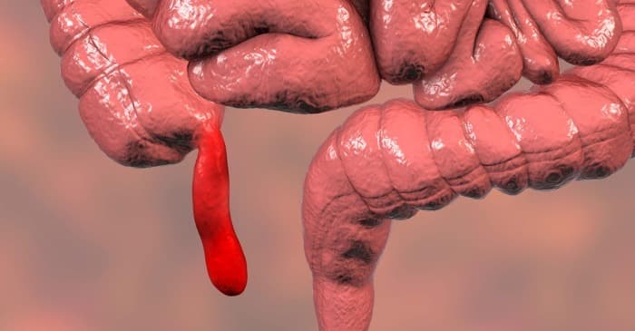 What happens before appendix removal?