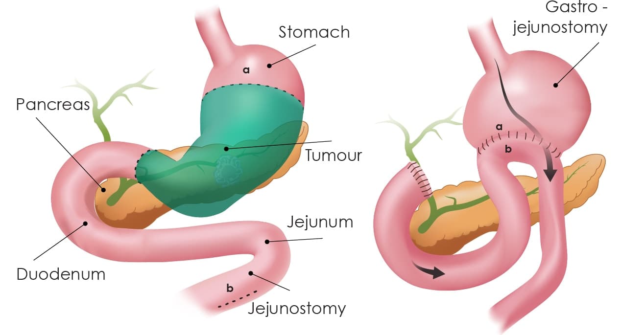 How is Gastrectomy procedure done?