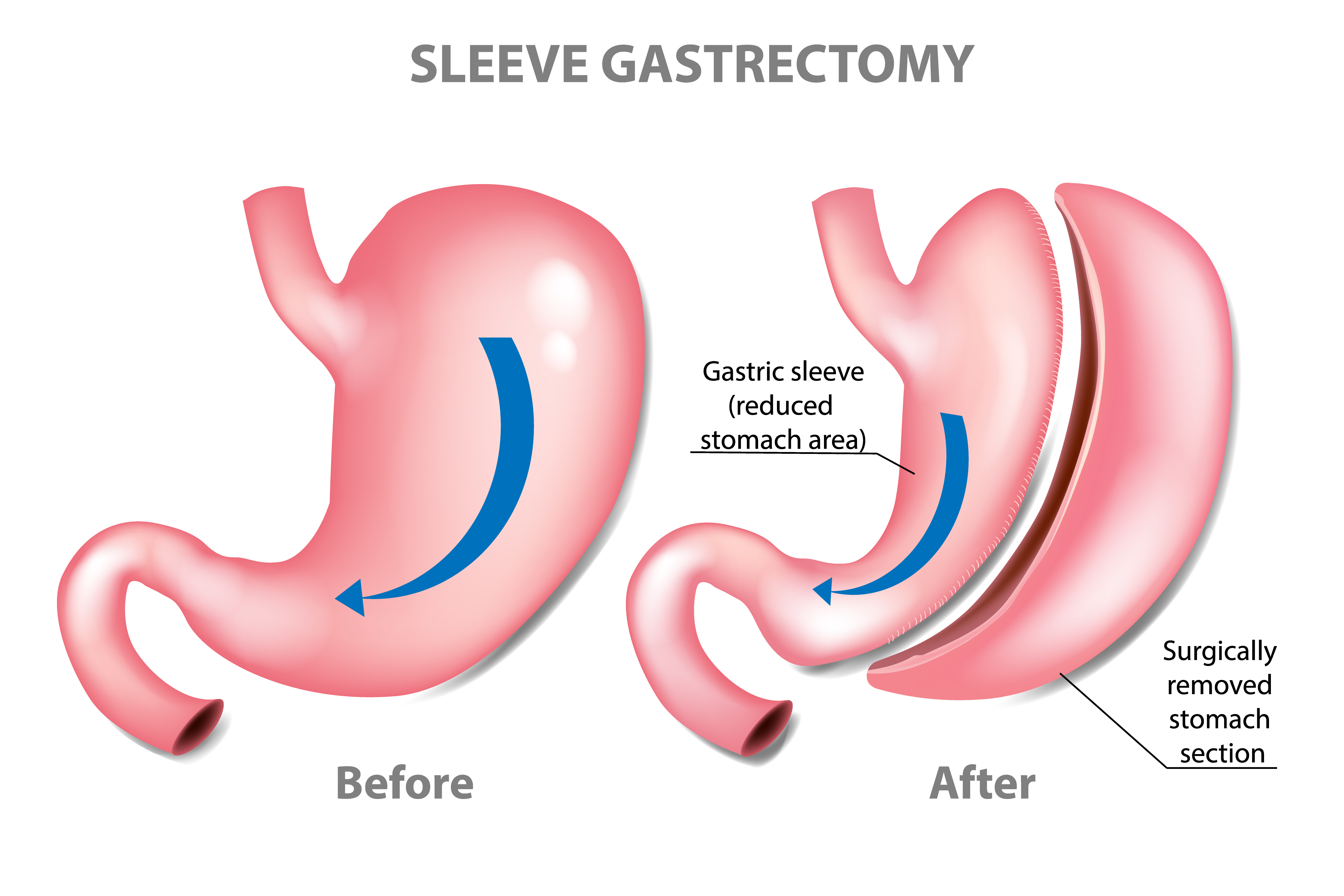 Gastrectomy risks & benefits