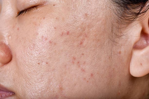 What is acne skin condition?
