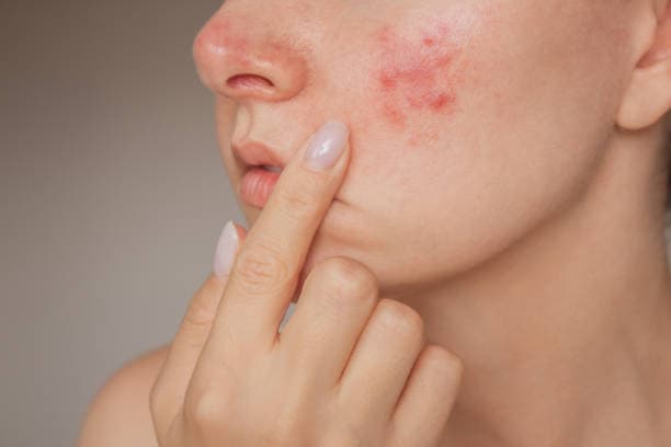 What are the types of acne?