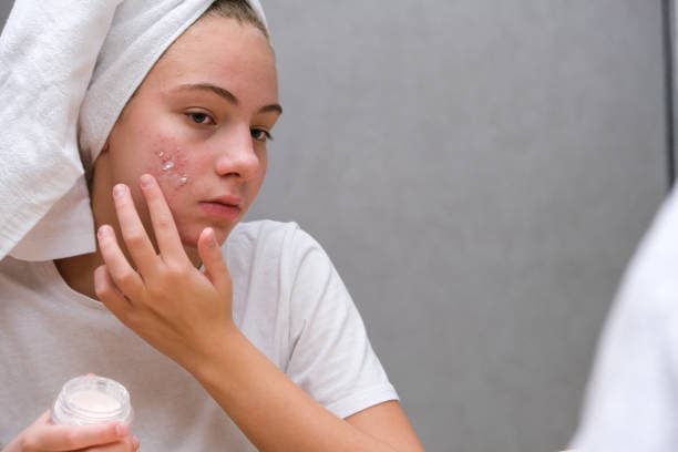 What is the cause of acne?