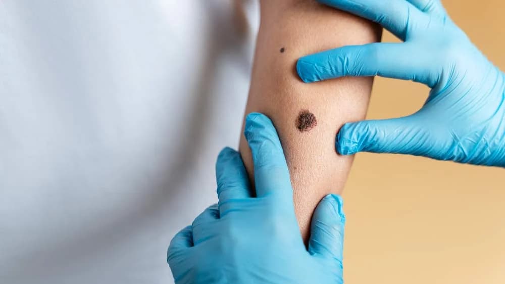 Skin Cancer: Stage & Treatments