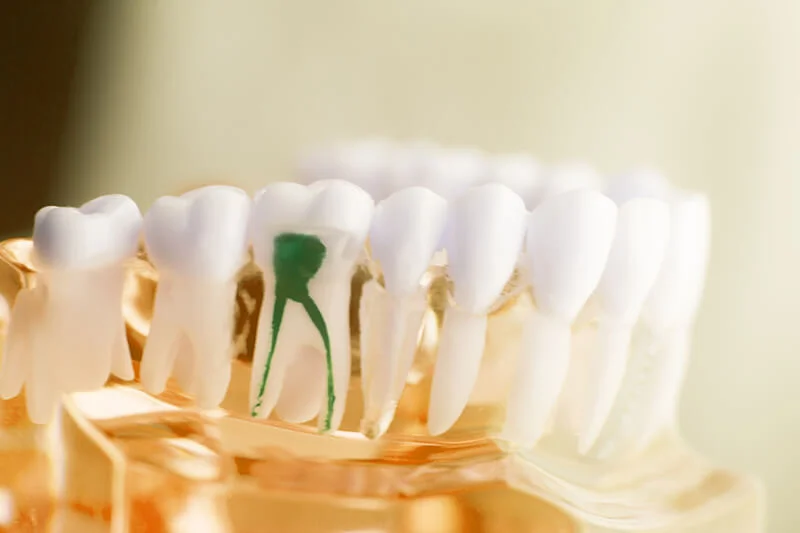 Everything you need to know about Endodontic Therapy