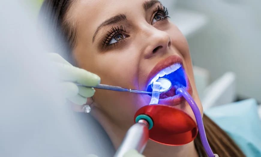 Teeth Whitening vs. Teeth Bleaching