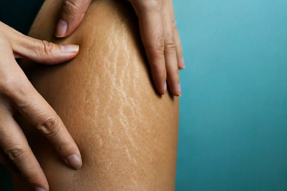 How to get rid of old Scars; different types of Scar Removal