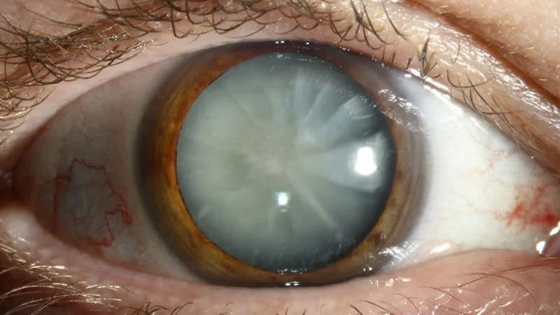 What are the signs of Cataract?