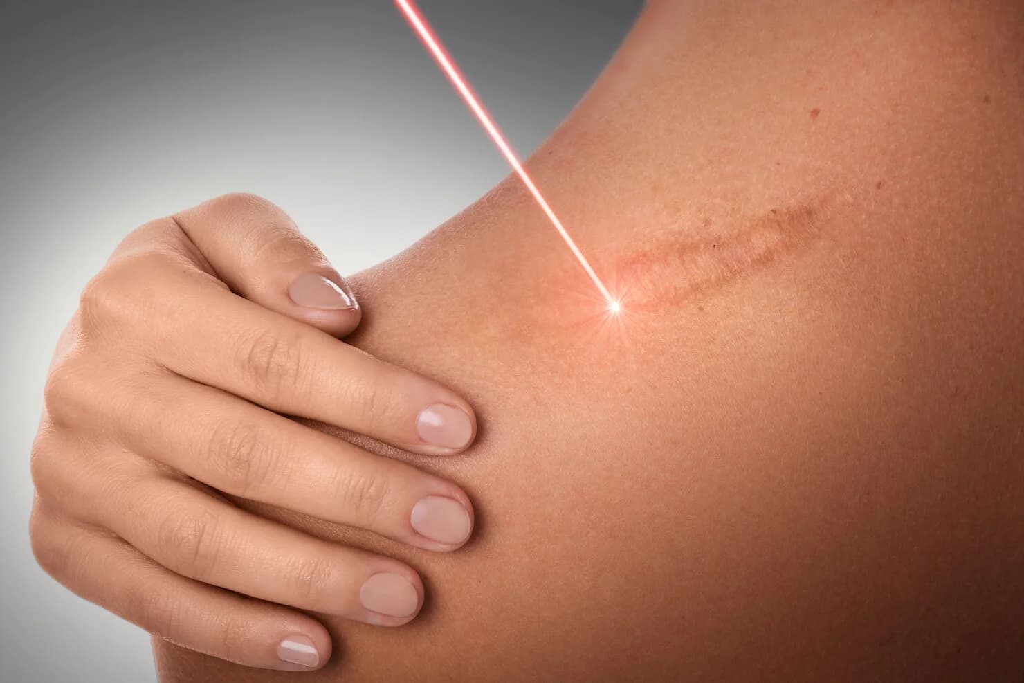 Laser Scar Removal: What you need to know