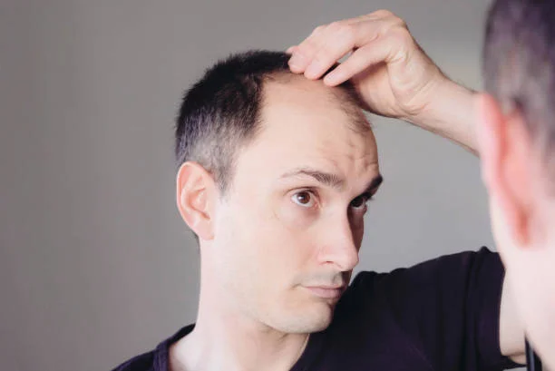 What are the side effects of Hair Transplant?