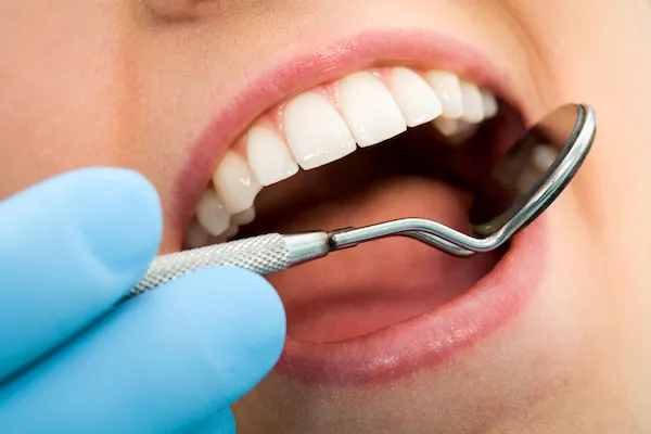 Appropriate age for Dental Composite