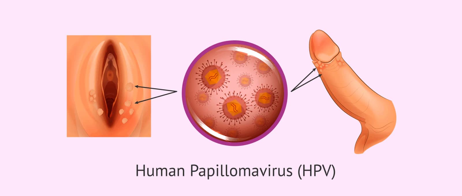 What is human papillomavirus (HPV)?