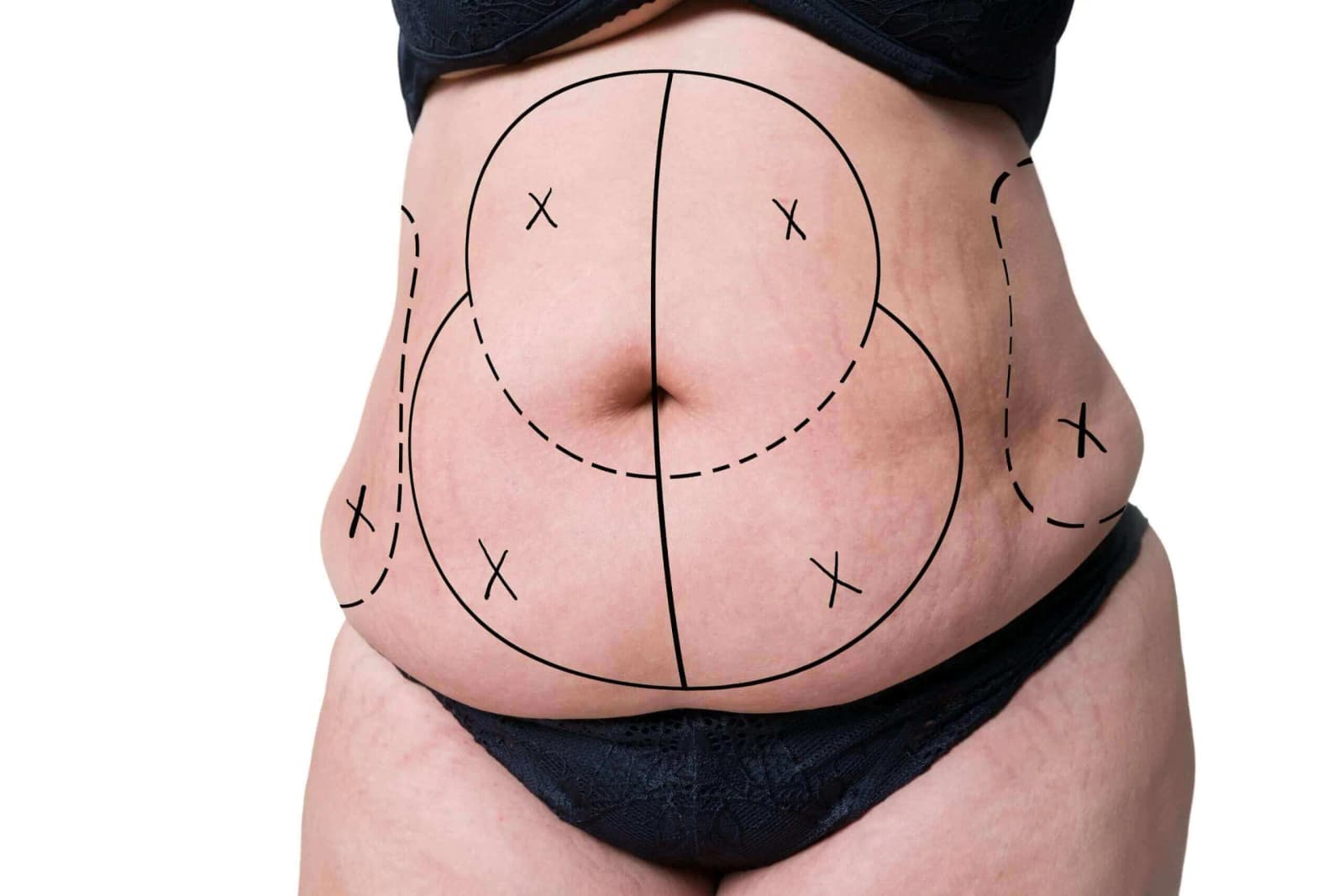 Abdominoplasty Cost in Iran 
