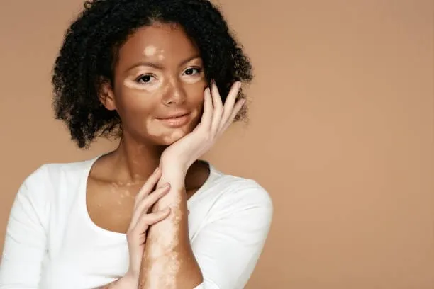 Vitiligo Treatment