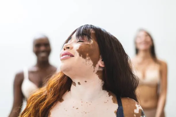Vitiligo treatment cost in Iran