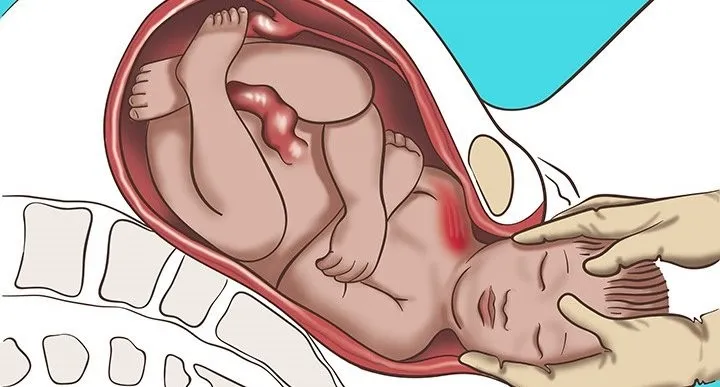 Erb’s palsy Treatment cost in Iran 