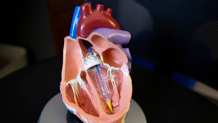 Aortic valve replacement surgery process