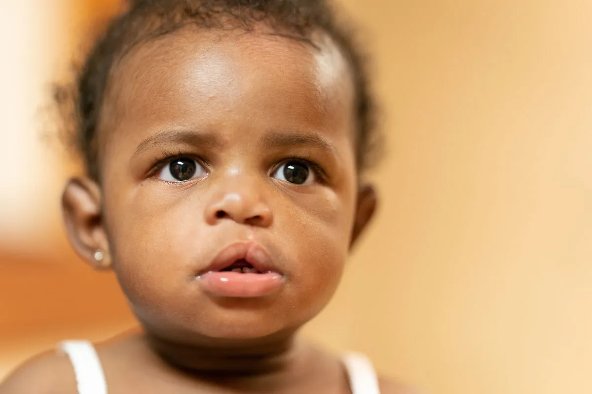 What is a Cleft Lip?