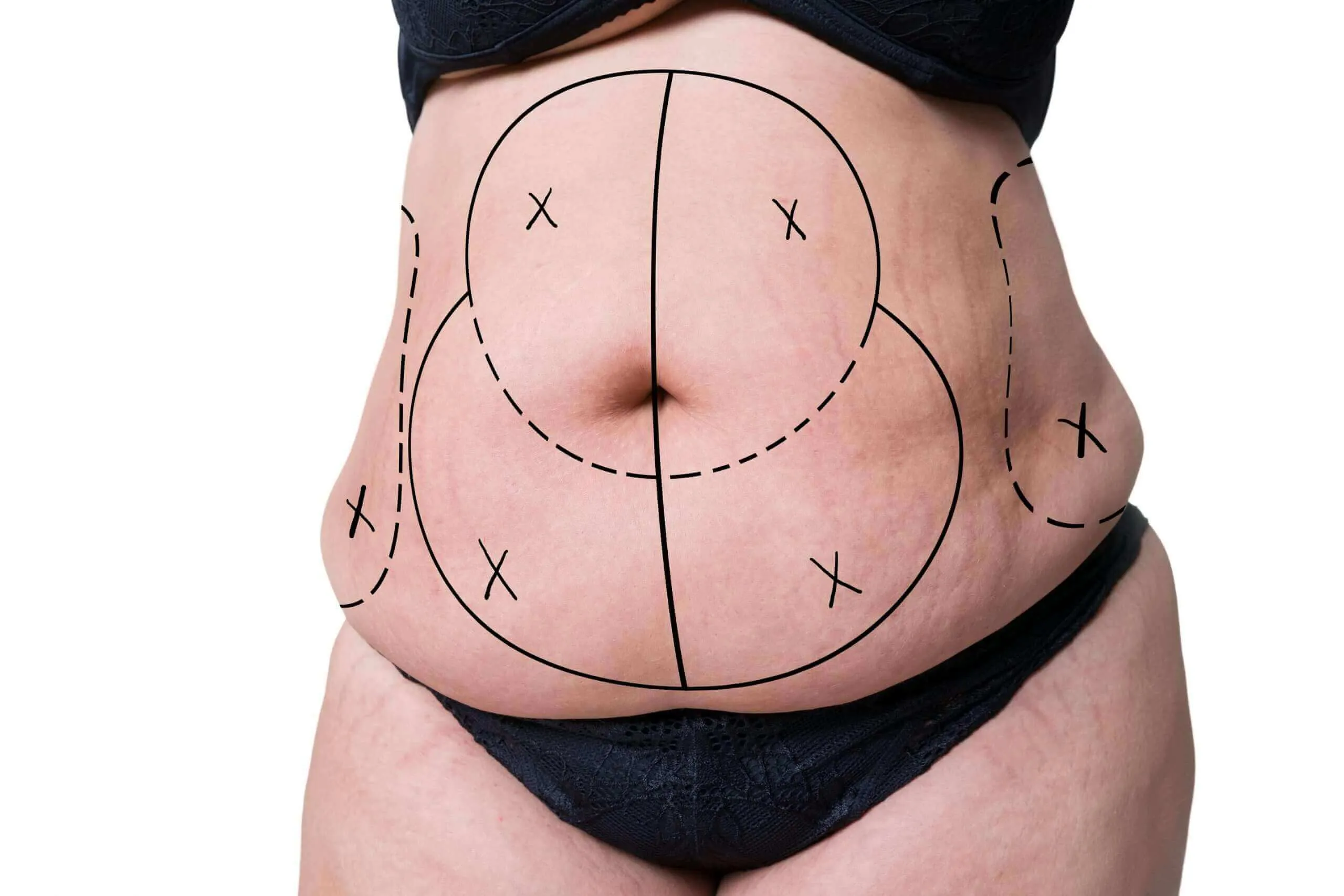 Abdominoplasty Cost in Iran