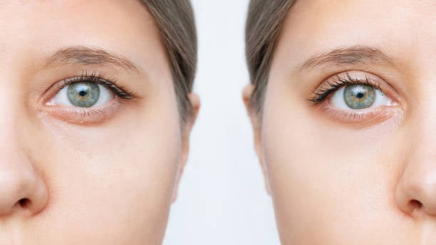 Ptosis Repair Surgery Vs. Blepharoplasty
