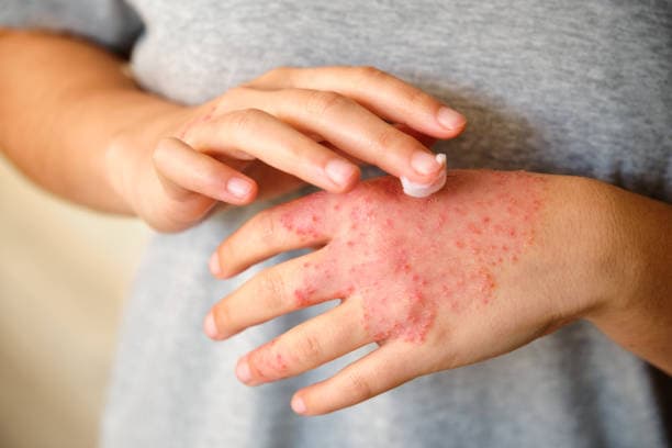 What is eczema?