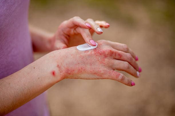 What are the treatment options for eczema?