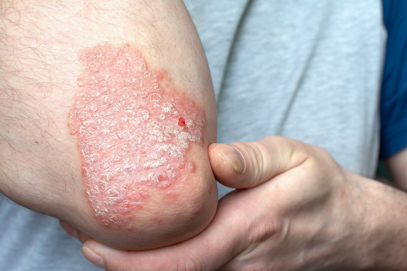 What is Psoriasis disease?