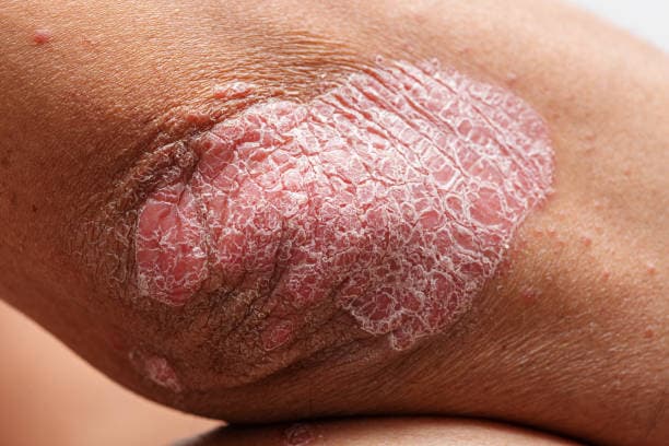 What is Psoriasis?