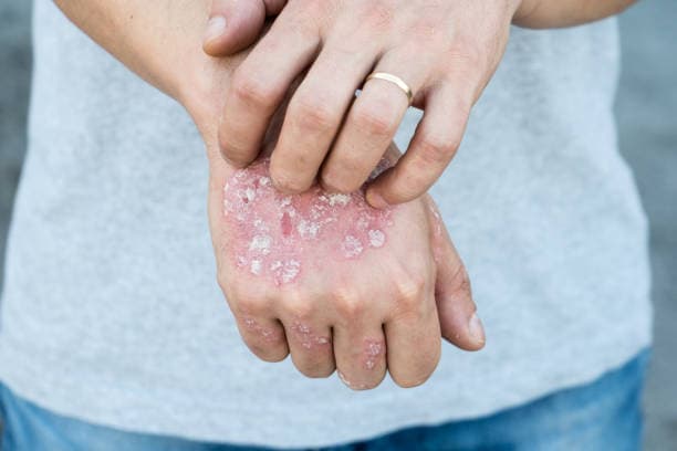 Which parts of the body does psoriasis usually affect?
