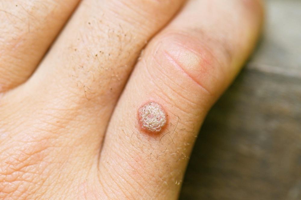 How to identify Warts?