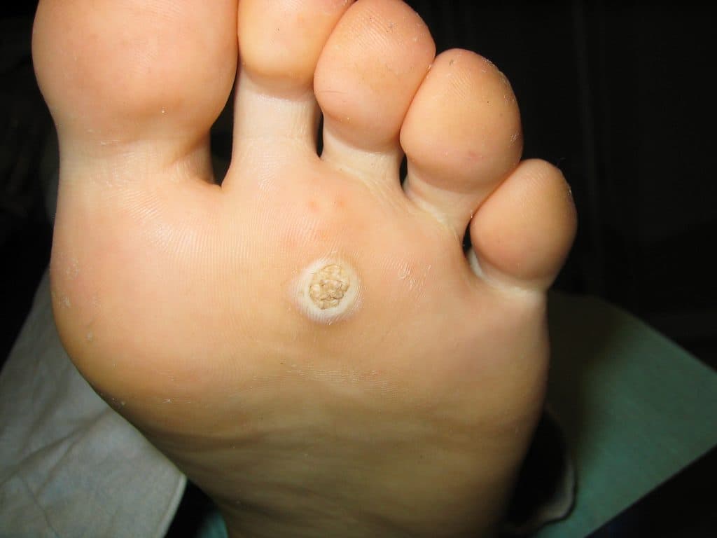 What are the causes of warts?