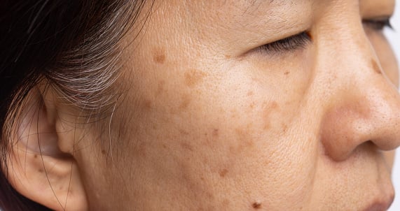 Treating the brown spots of Melasma