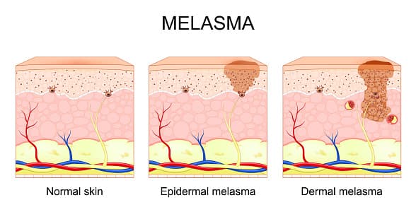 What are the types of melasma?