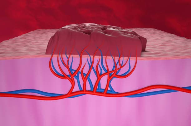 What is a strawberry hemangioma?