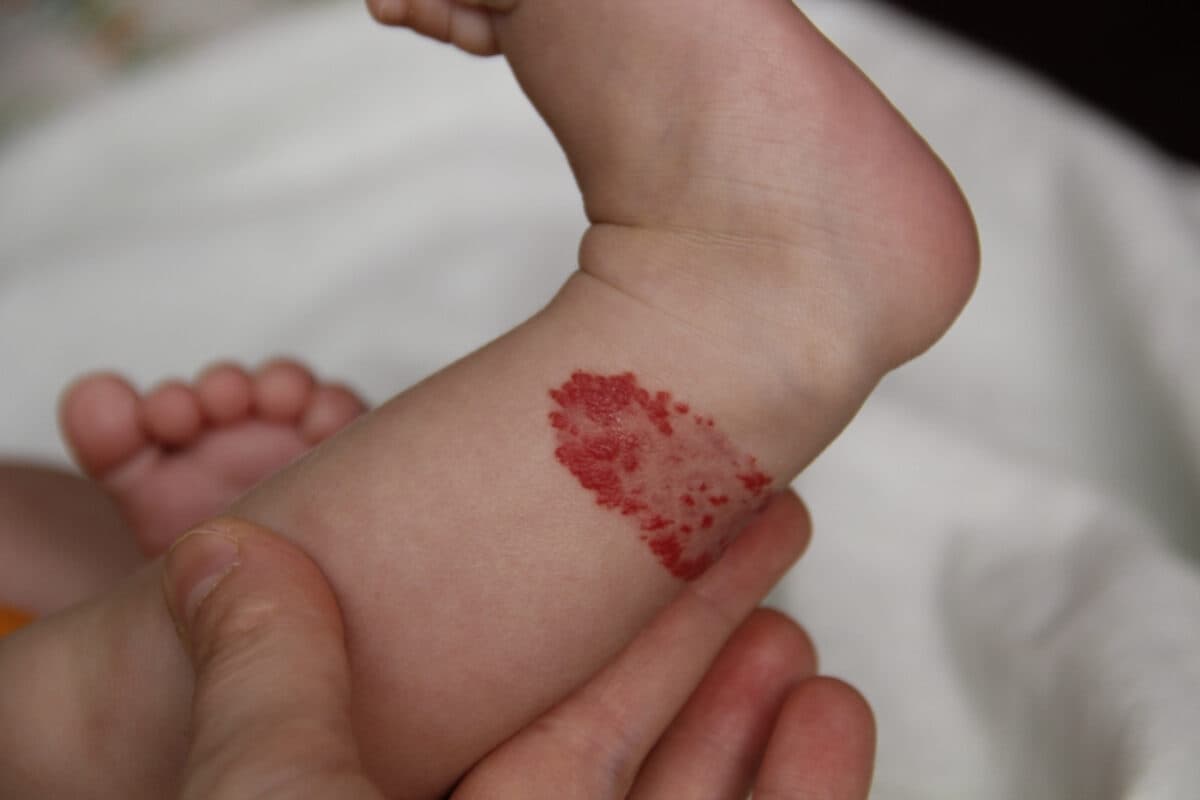 What are the risk factors for strawberry hemangiomas?