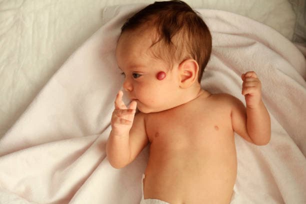 How are strawberry hemangiomas treated?