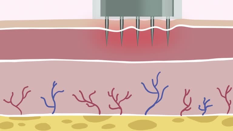 What happens during a microneedling treatment?