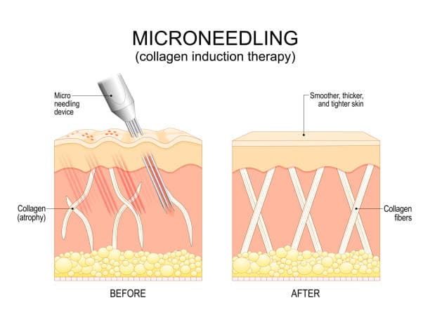 Microneedling aftercare process