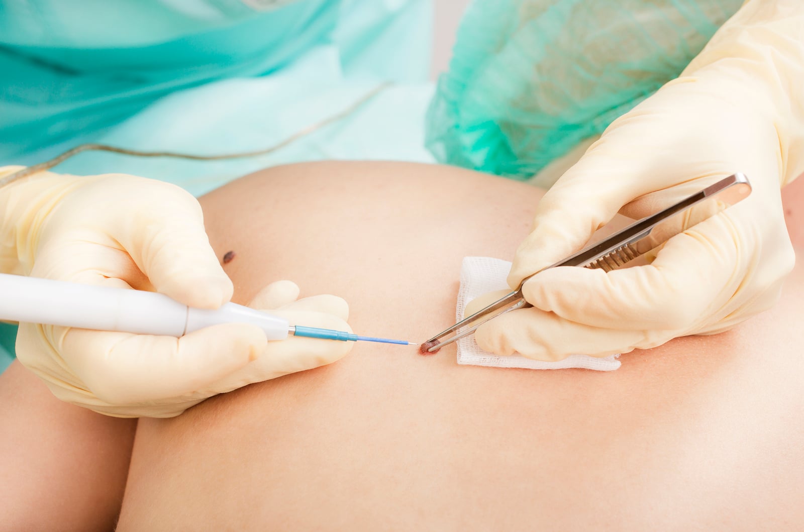 Mole Removal procedure types