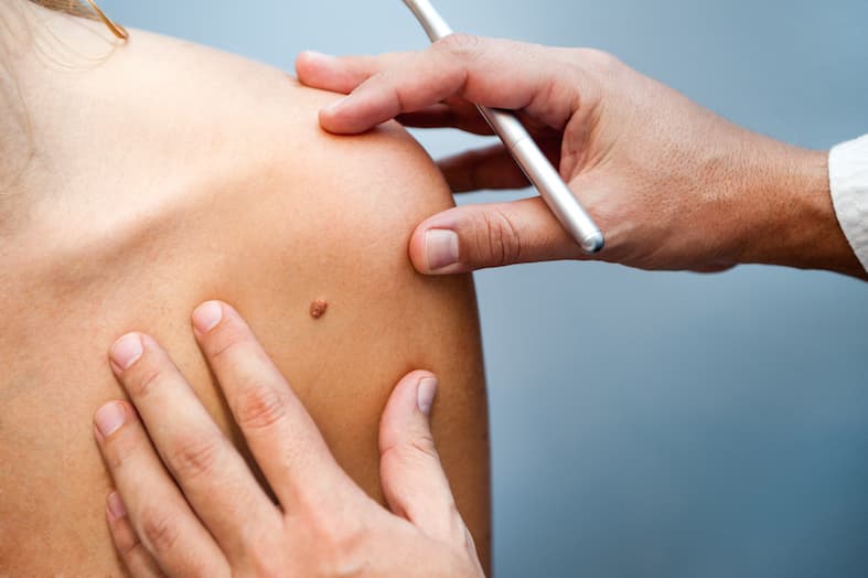What is mole removal?