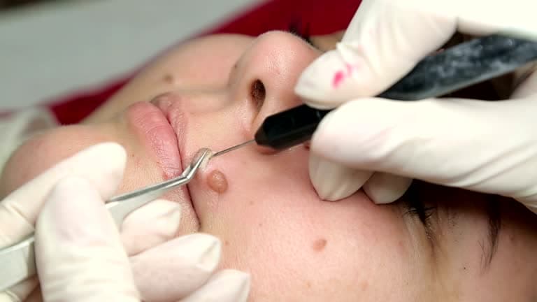 What are the types of mole removals?