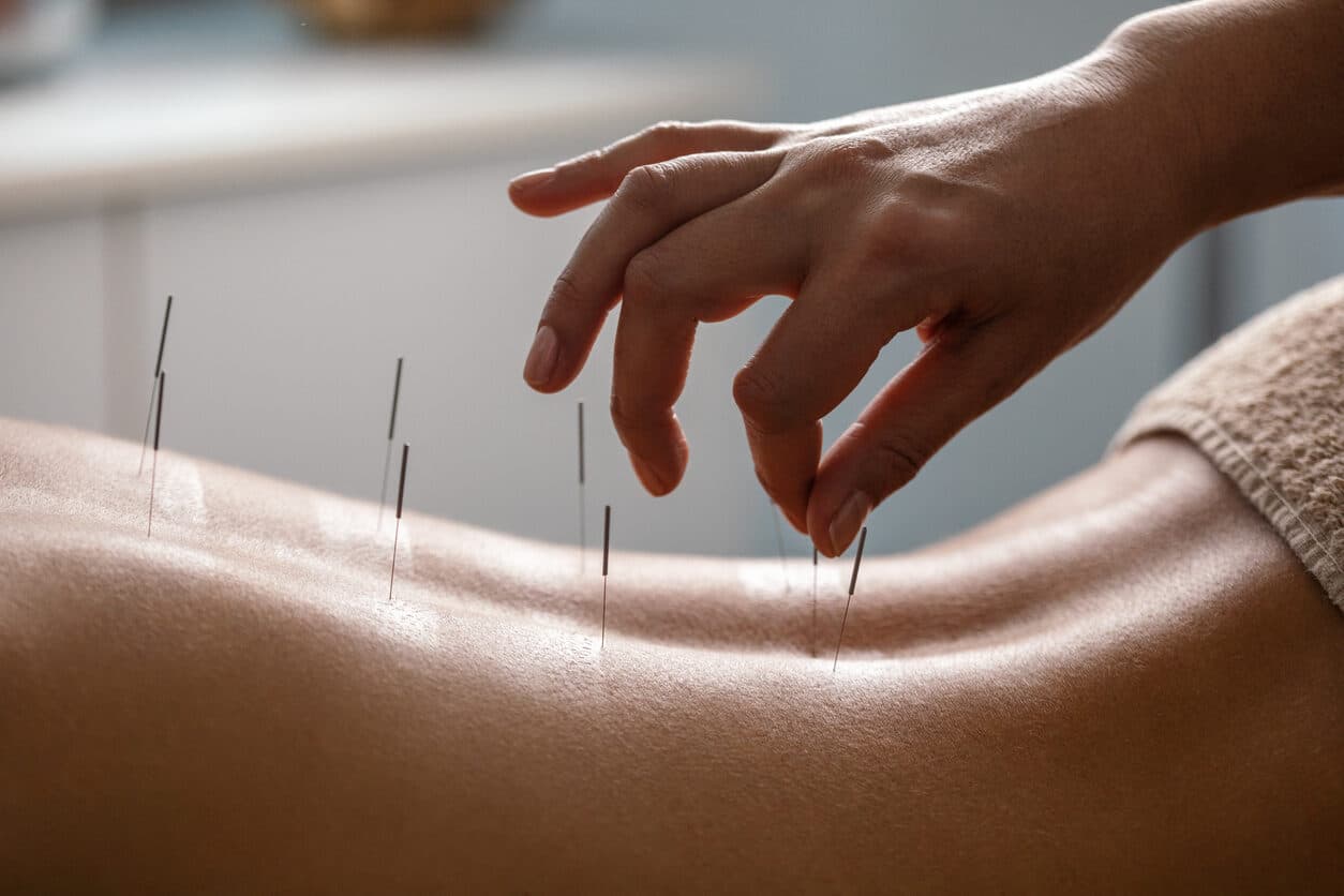 What is acupuncture?