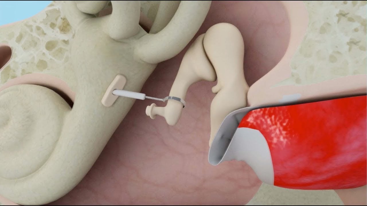 Stapedectomy: the hearing loss treatment