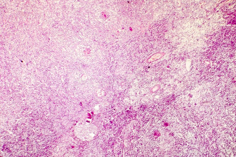 What is coagulative necrosis?