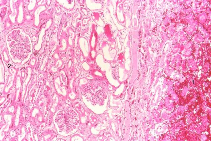 What are the causes & symptoms of coagulative necrosis?