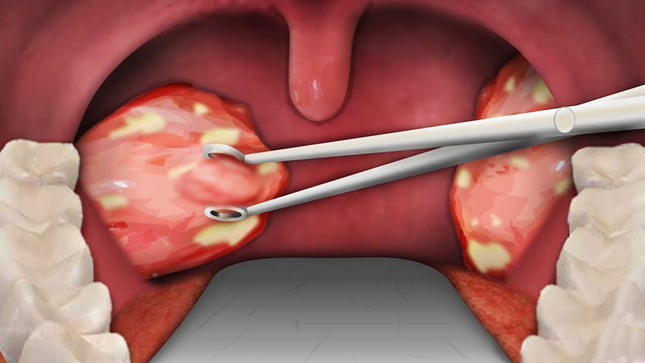 What Is Tonsillectomy?