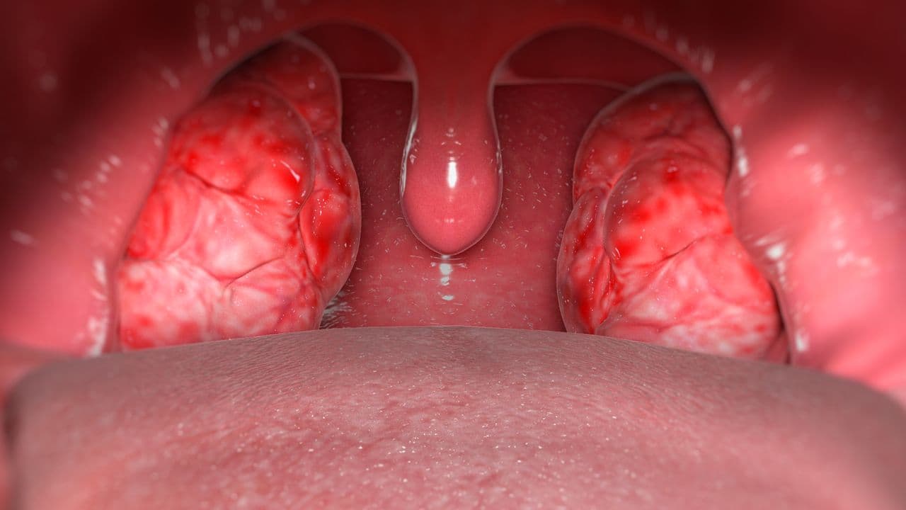 Why should I have Tonsillectomy?