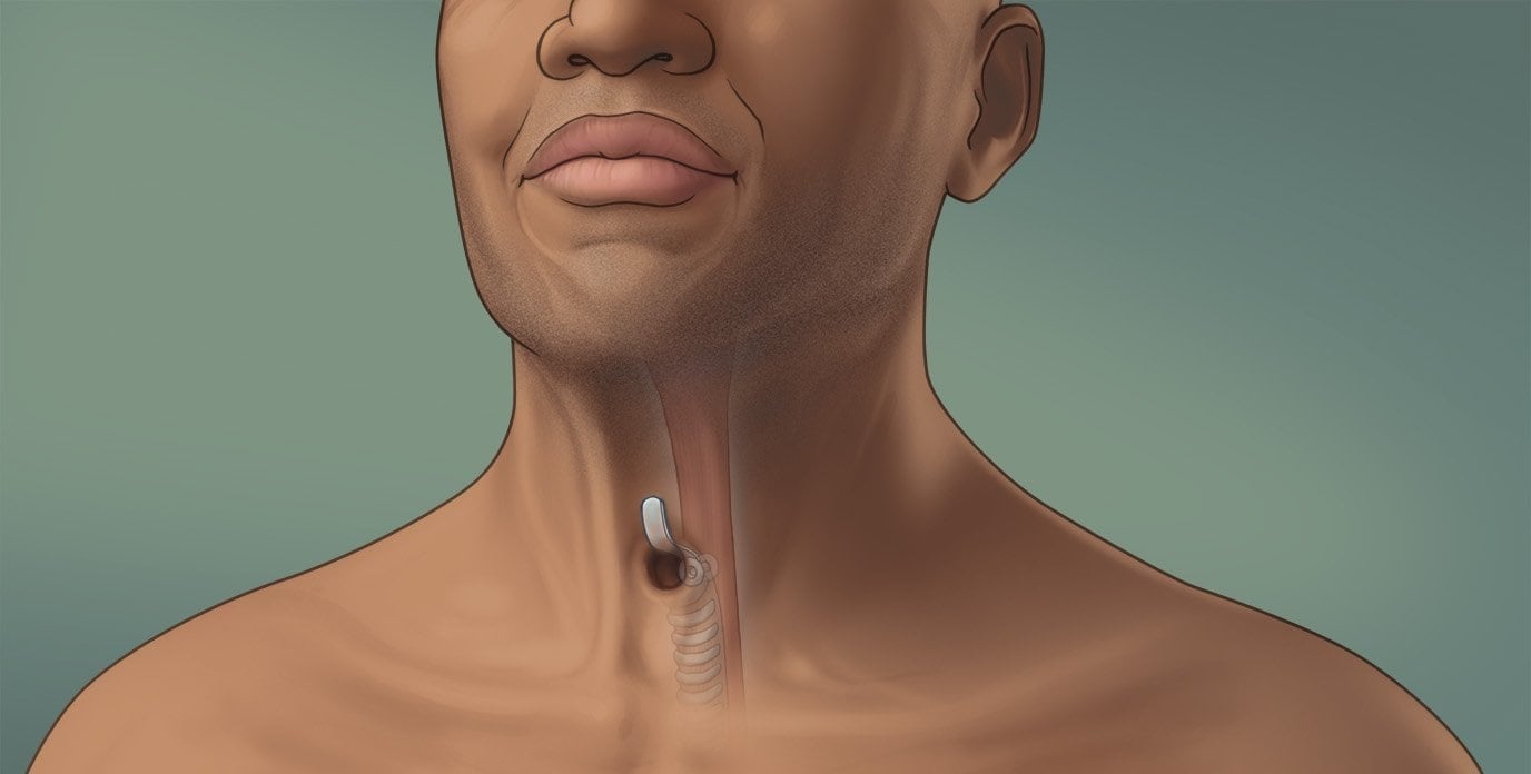 What is laryngectomy?