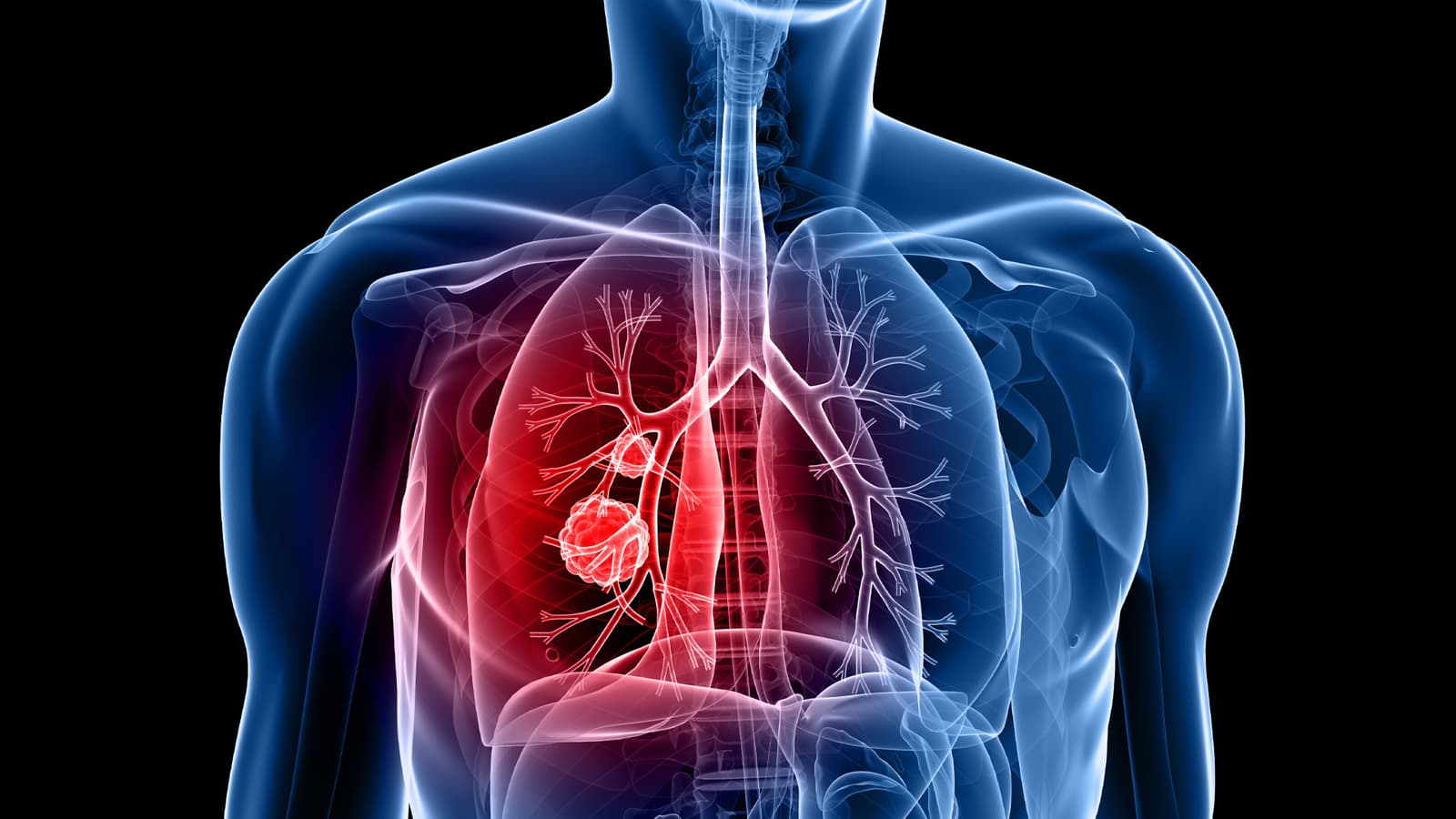 What is chronic bronchitis?